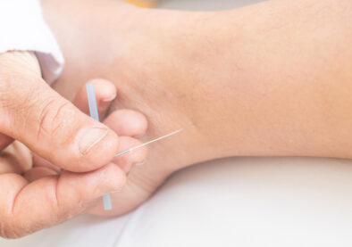 Dry Needling Physiotherapy in Morinville 2