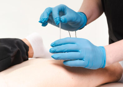 Dry Needling Physiotherapy in Morinville 3